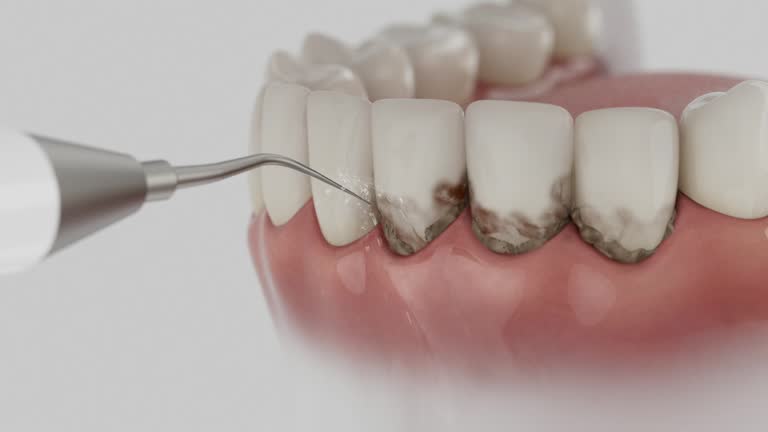 Reliable Tooth Extraction contractor in Spanish Fork, UT by Smile Center Dentistry